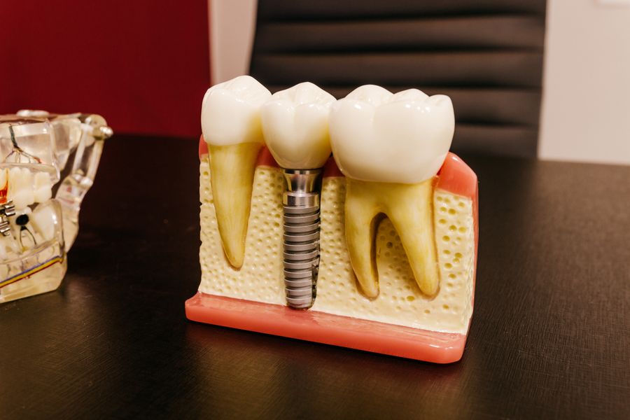 Implantes - Clínica Yamada Odontologia