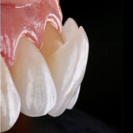 Lentes de Contato Dental - Clínica Yamada Odontologia